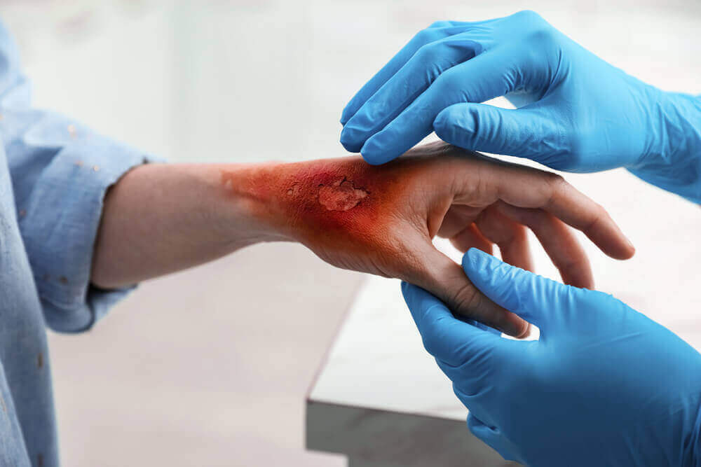 Doctor treating burn injury hand.